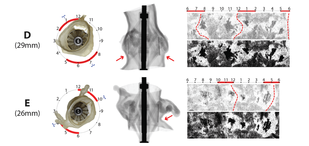 pre-procedural-fit-testing-transcatheter-aortic-valve-replacement-tavr-valves-using-parametric-modeling-3d-printing-10 pre-procedural-fit-testing-transcatheter-aortic-valve-replacement-tavr-valves-using-parametric-modeling-3d-printing-10